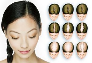 hair loss protection