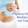 10 Ways To Manage and Treat Hemorrhoids During Pregnancy