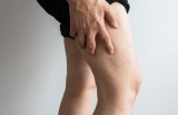 Are Spider Veins Symptoms of Something Worse?