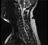 Common Causes Of Chronic Neck Pain