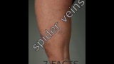 The Facts about Varicose Veins and Spider Veins That You Must Know