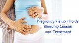 10 Ways To Manage and Treat Hemorrhoids During Pregnancy
